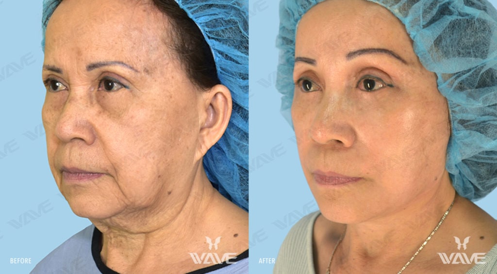 Anti-Aging Treatments For People in Their 30s, 40s, 50s, 60s, and 70s qtFL NL LB ENDO BL 1181x650 F5
