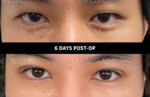 before and after upper bleph surgery