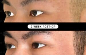 Wave Plastic Surgery - before and after upper bleph