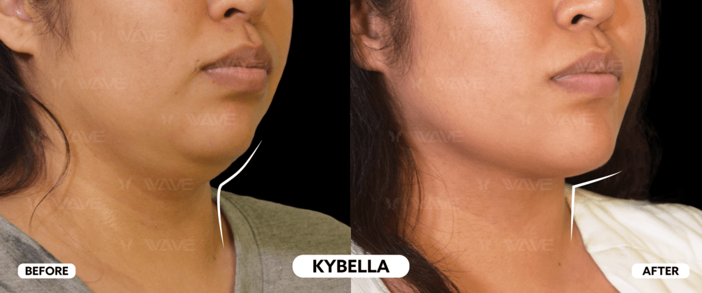 How Can I Fix My Side Profile? Expert Solutions for a Balanced Facial Profile Kybella