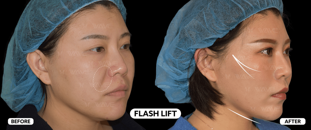 Choosing the Right Procedure: Fillers vs. Thread Lifts Flash lift