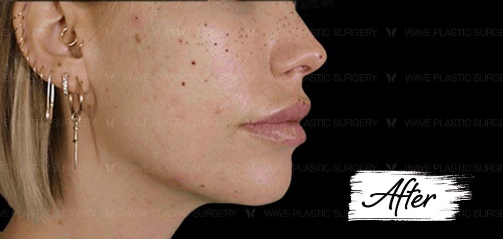 Ultherapy Ultherapy 3