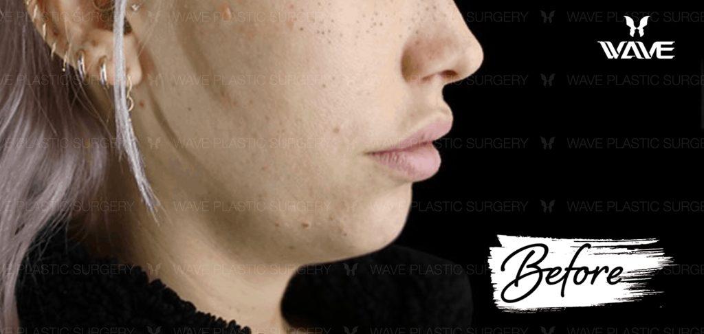 Ultherapy Ultherapy 4