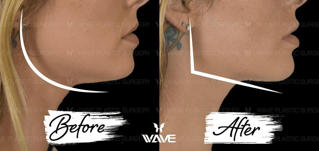 Ultherapy Ultherapy 6