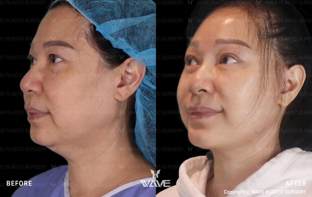 Facelift for Younger Patients: How Young is Too Young? Face Neck Lift 05