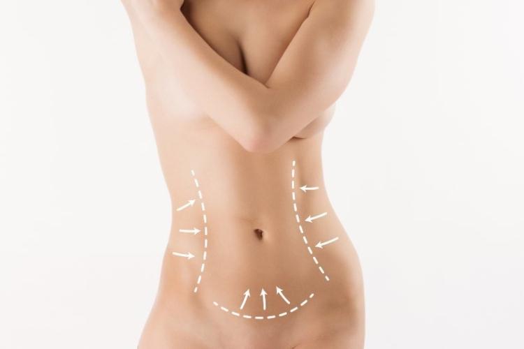 liposuction in los angeles