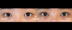 Wave Plastic Surgery - double eyelid before and after photo