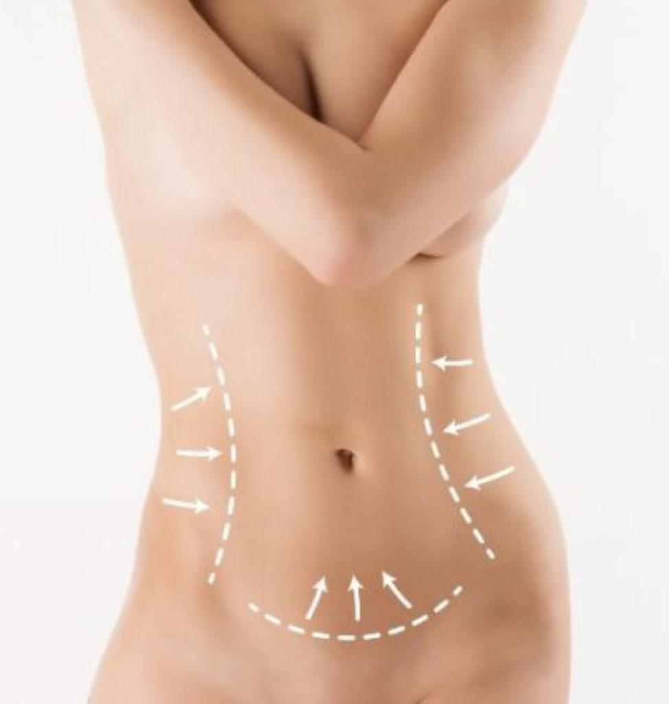 Love Handles Liposuction Los Angeles