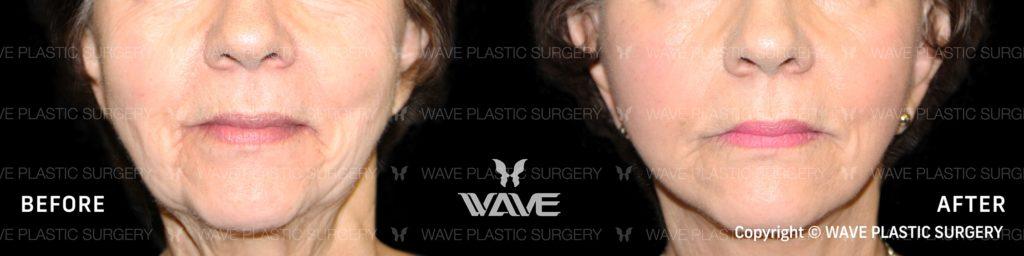 Cure Lift S Before and After Photo