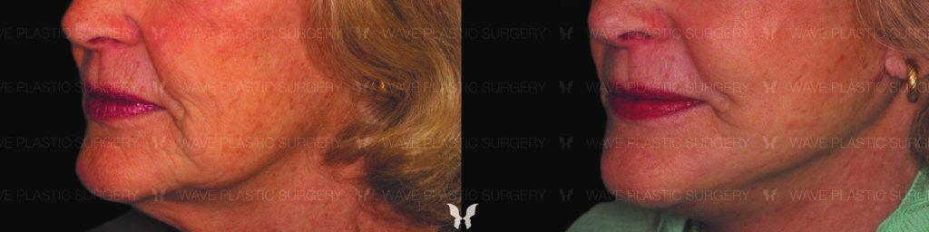 cure-lift-s-before-and-after-2.1