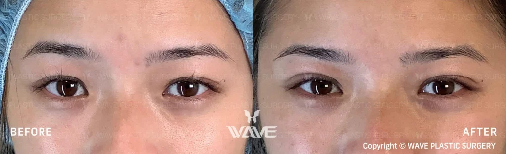 Upper Blepharoplasty on female patient