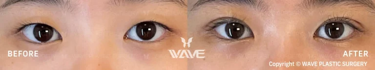 Before after upper eyelid surgery