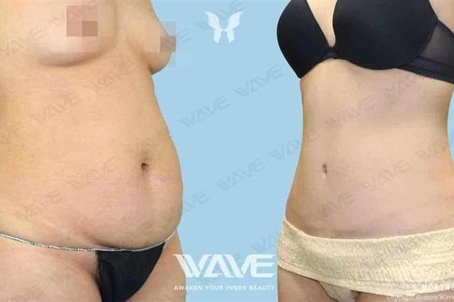 Specials tummytuck 1