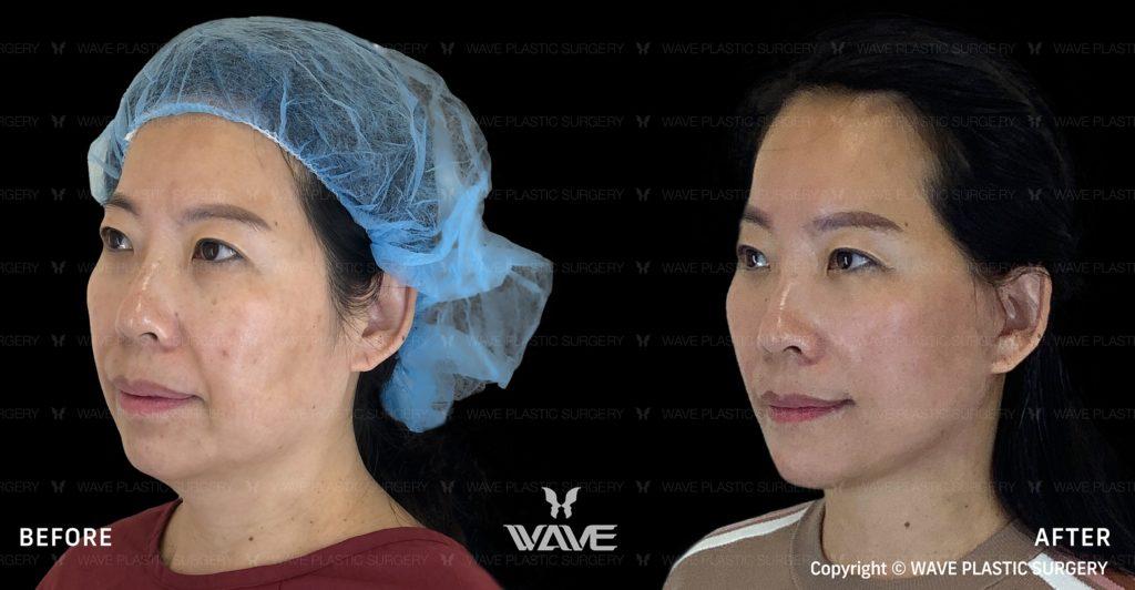 How Can I Fix My Side Profile? Expert Solutions for a Balanced Facial Profile Special Page Full Face Neck Lift