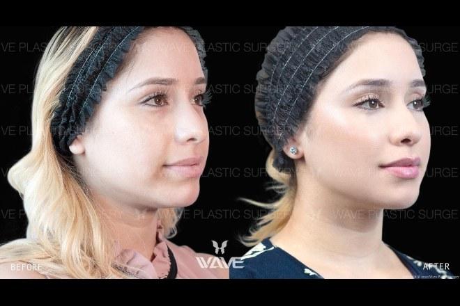 Specials wave injectables special