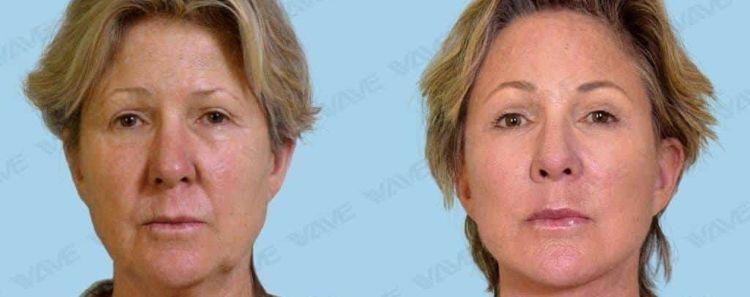 Can You Reverse Sagging Jowls? facelift 13a 1