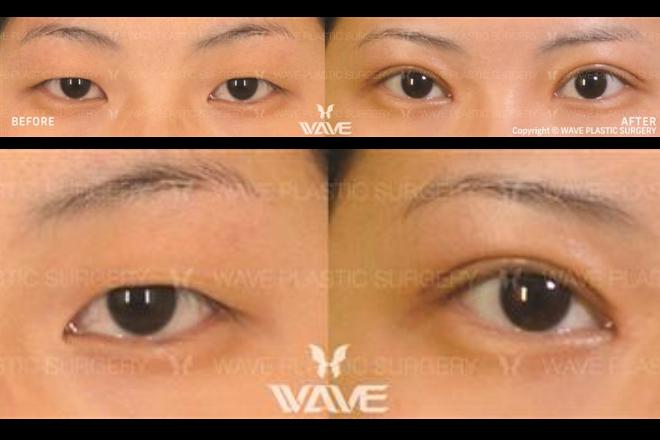upper bleph eyelid surgery