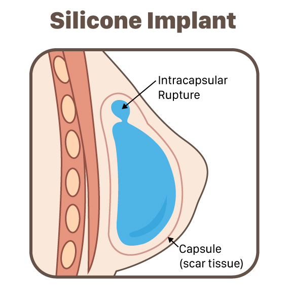 What Causes Rippling In Breast Implants?