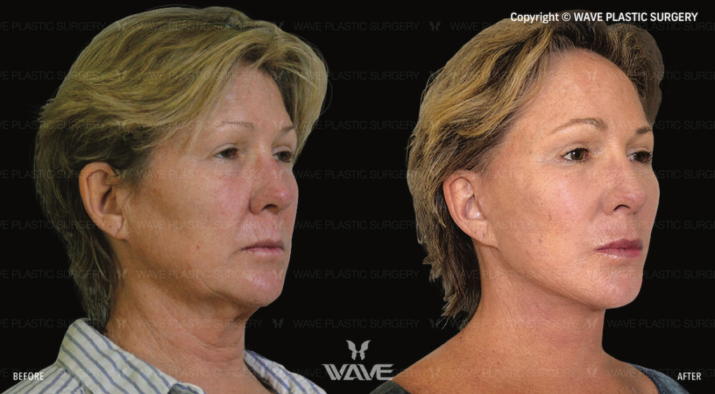 ConsultBook_FaceLift_2