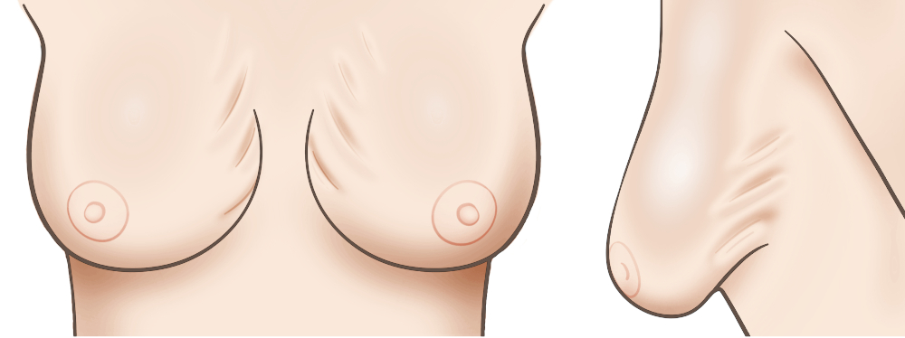 Breast Implant Revision breast rippling diagram 2