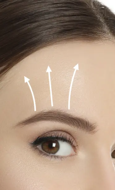Brow lift: arrows point upwards from a woman's brow towards her hair