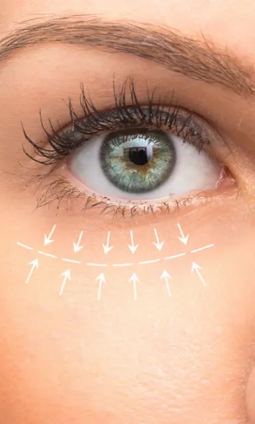 Lower eyelid surgery: arrows go inward towards the area underneath a woman's eye