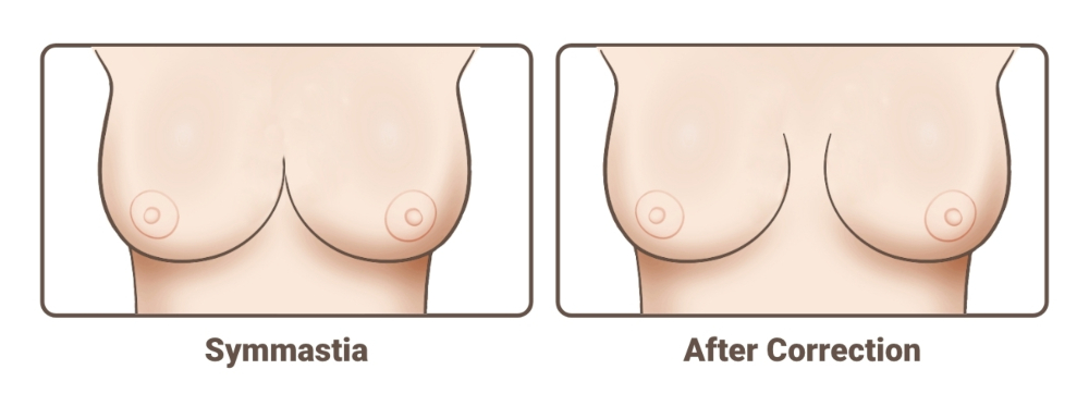 Breast Implant Revision symmastia diaram