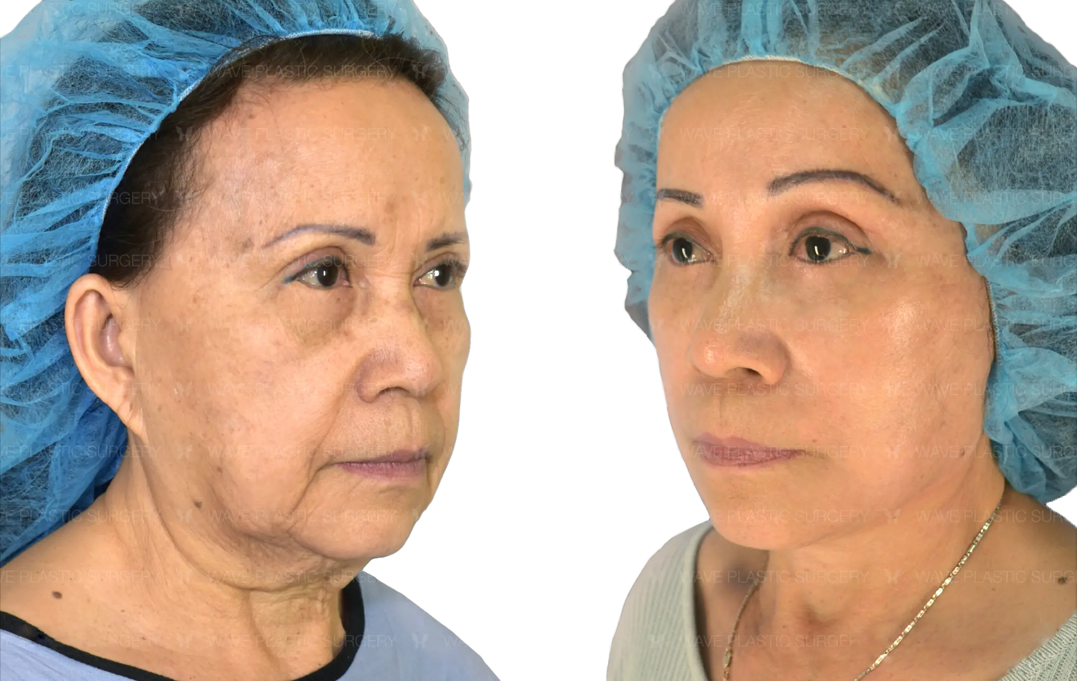 Before and after anti-aging procedures