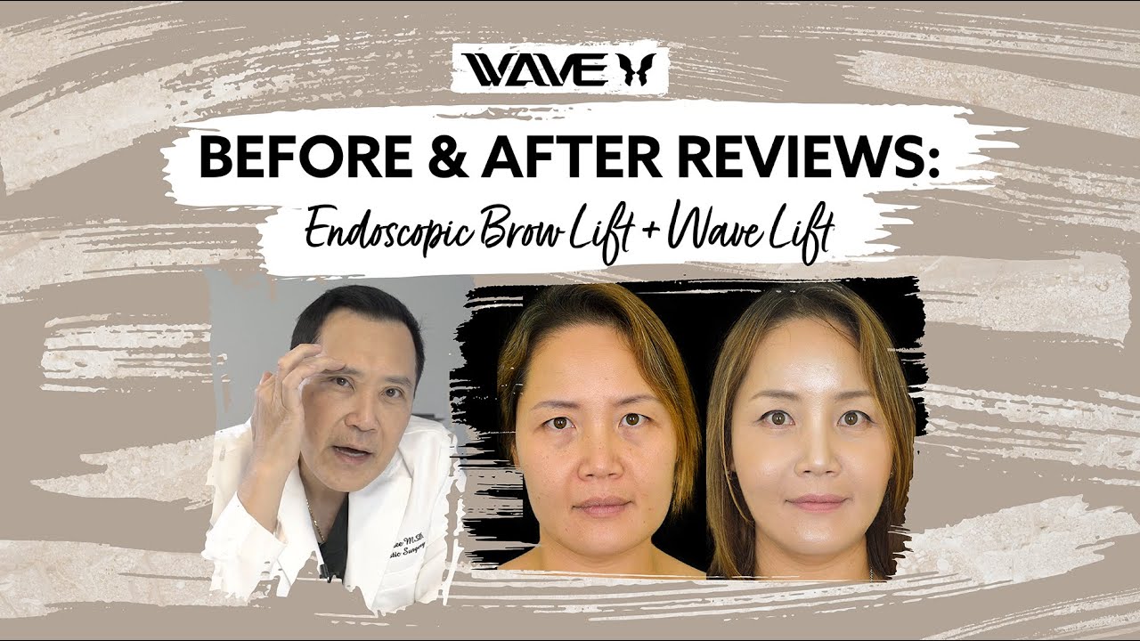 Brow Lift before and after endoscopic brow