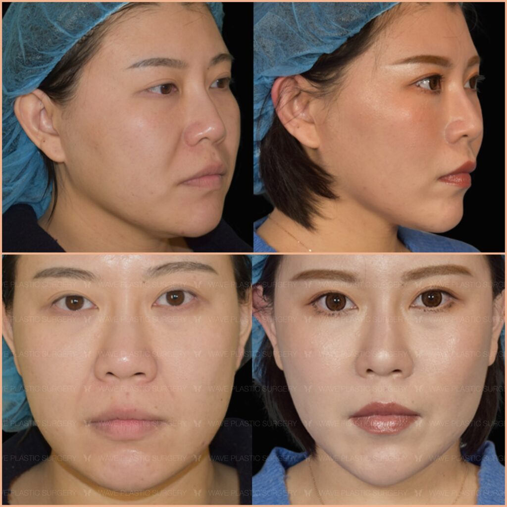 Flash Lift Thread Lift Special