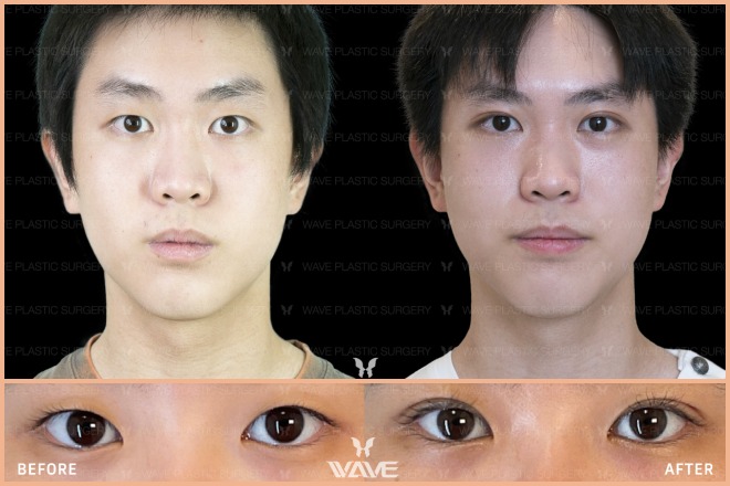 Upper Eyelid Surgery Promo