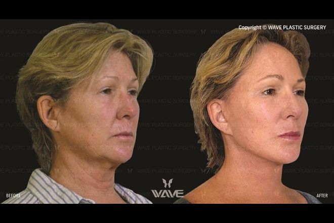 Specials beforeaftertransformations