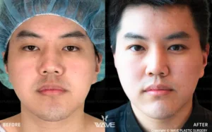 Upper Blepharoplasty