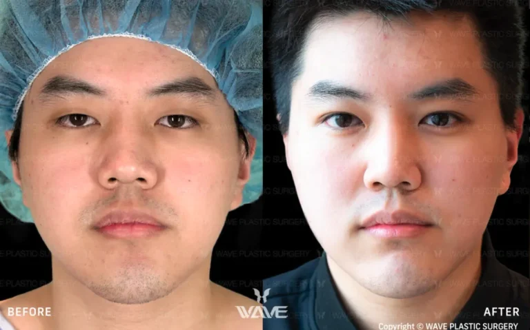 Upper Blepharoplasty