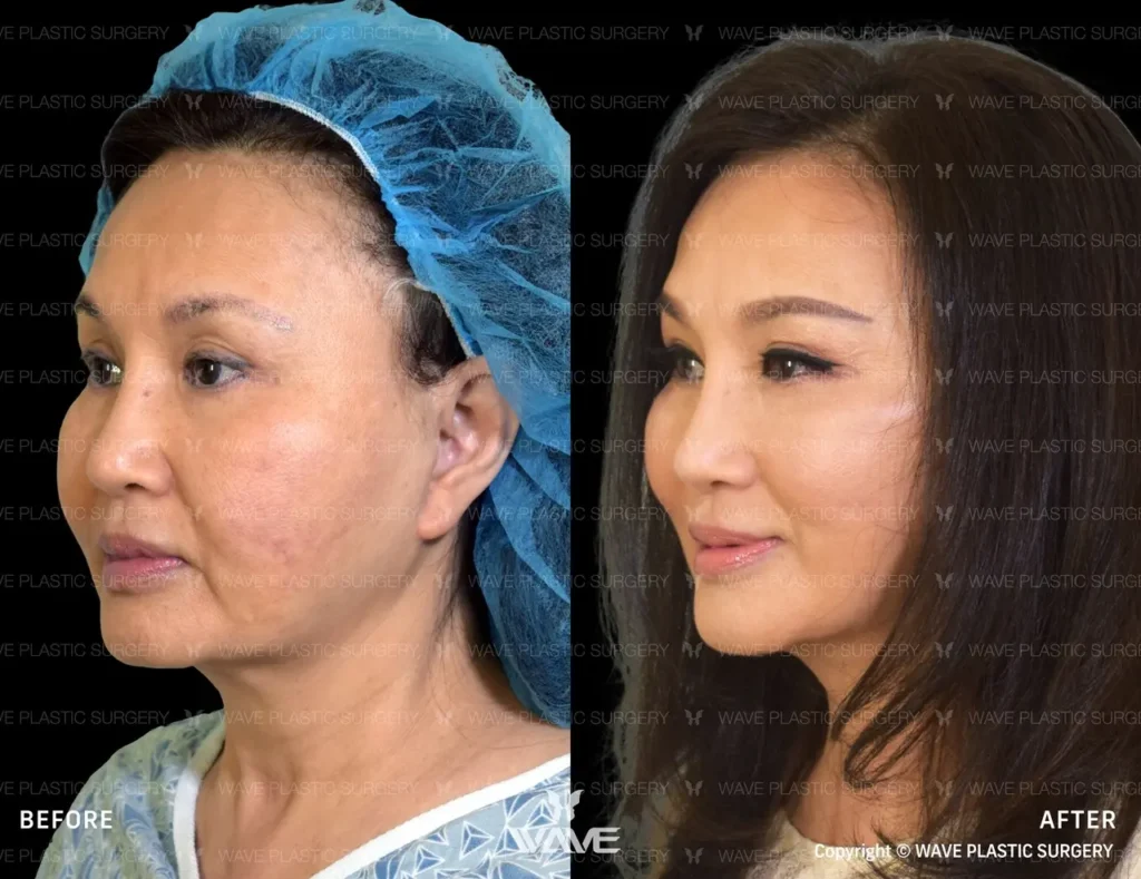 Facelift in San Francisco 45 Jackie Nguyen Wavelift Large