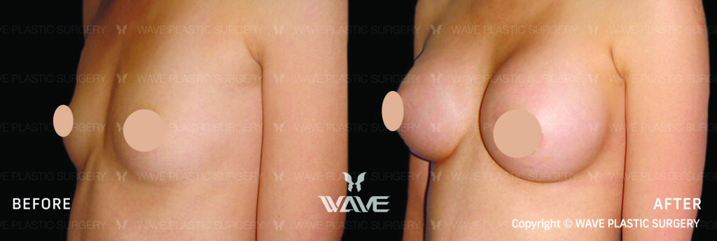 Specials Breast 3 1