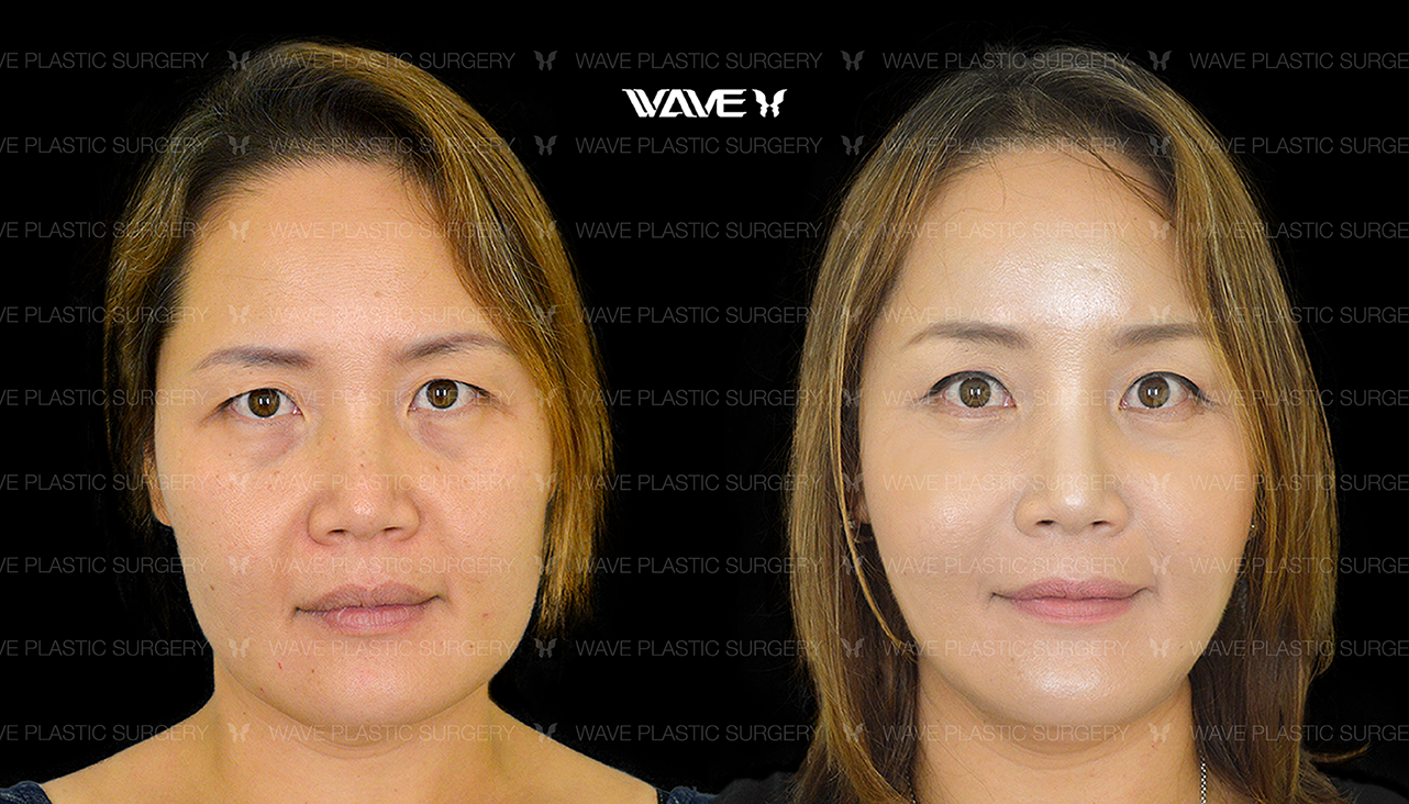 How Much Does a Facelift Cost? | Wave Plastic Surgery