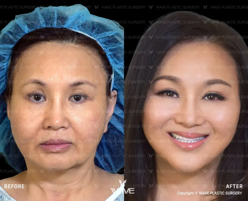 Wavelift client, Jackie_Nguyen
