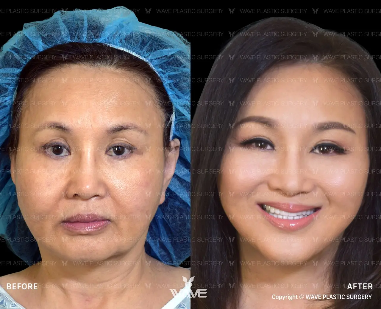 Wavelift client, Jackie_Nguyen