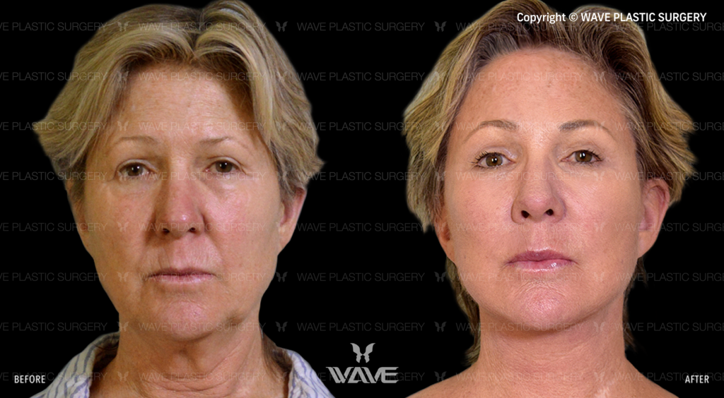 Wave Plastic Surgery Facelift Procedure Before and After results
