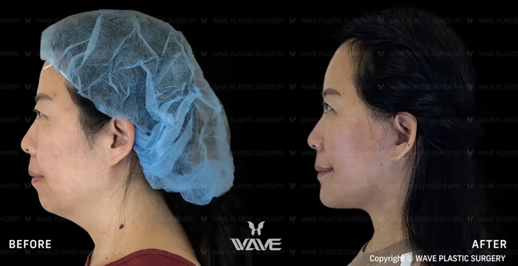 How to Massage Your Face After a Facelift: A Comprehensive Guide Side Sophia Ren Facelift Large