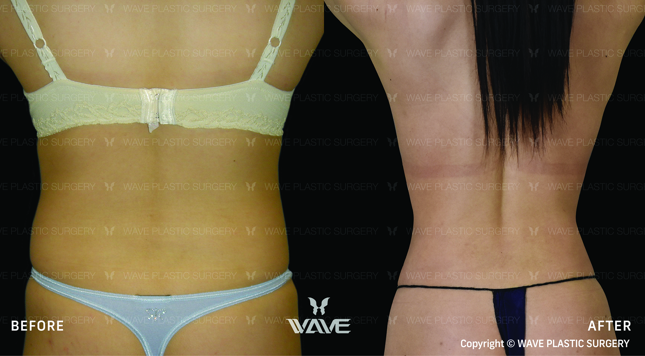 Specials liposuction