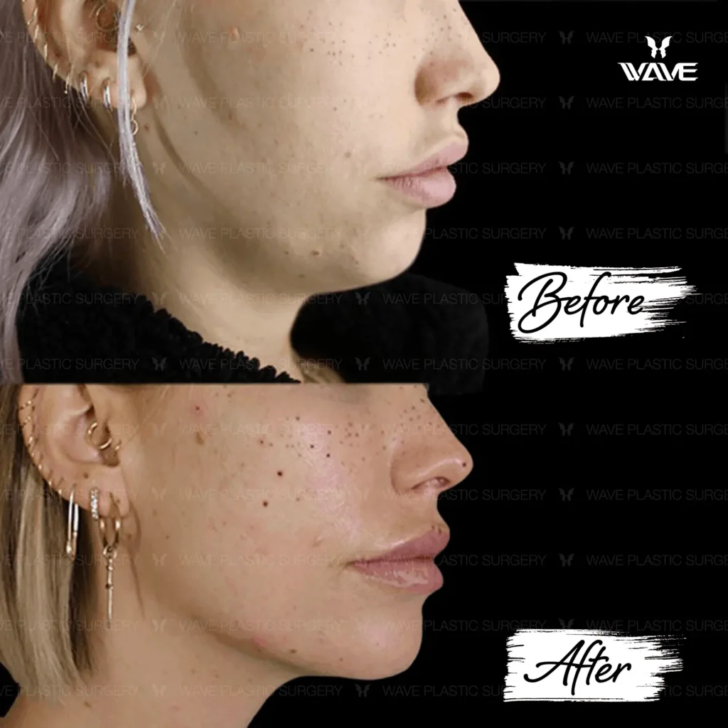 How to Tighten the Skin Under Your Chin Ultherapy copy