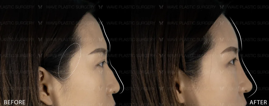 Pyramid Rejuvenation with Dermal Fillers MicrosoftTeams image 160 1