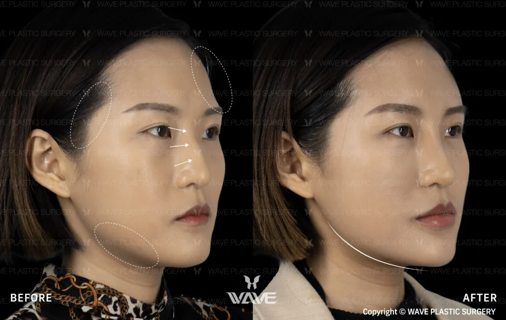 Pyramid Rejuvenation with Dermal Fillers MicrosoftTeams image 161 1