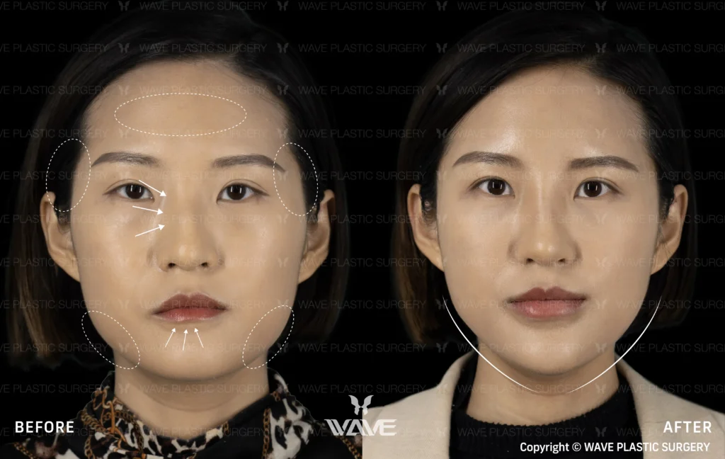 Pyramid Rejuvenation with Dermal Fillers MicrosoftTeams image 162 1