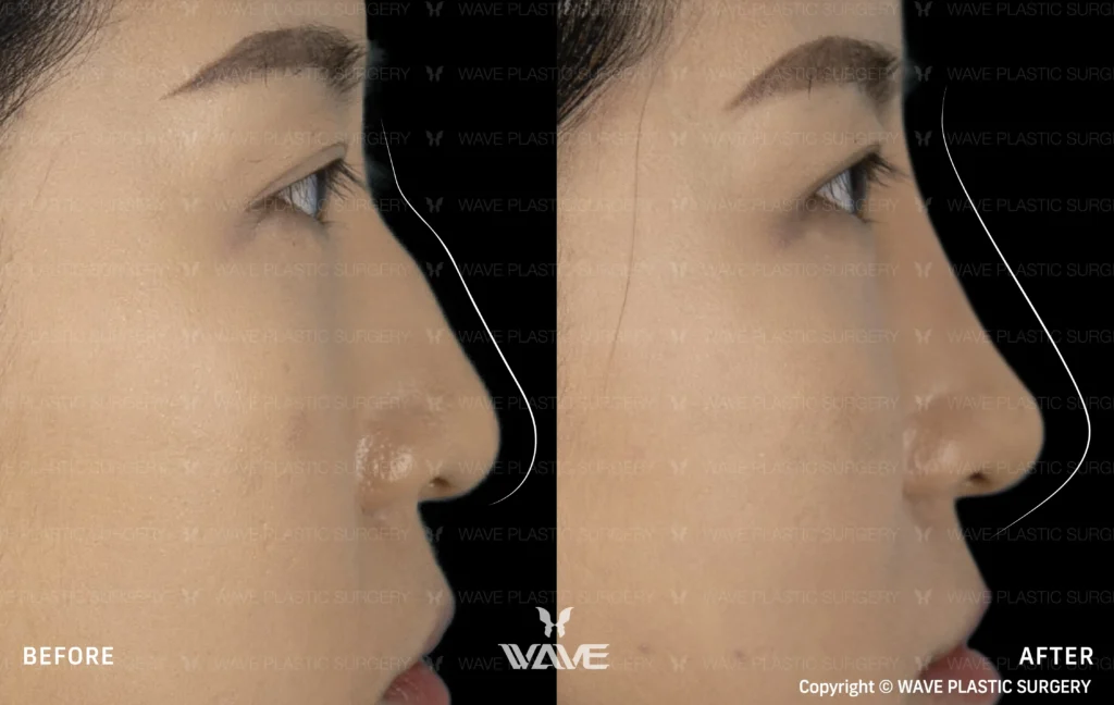 Pyramid Rejuvenation with Dermal Fillers MicrosoftTeams image 163 1