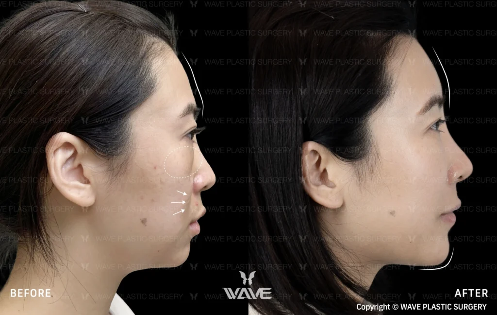 Pyramid Rejuvenation with Dermal Fillers MicrosoftTeams image 210 1