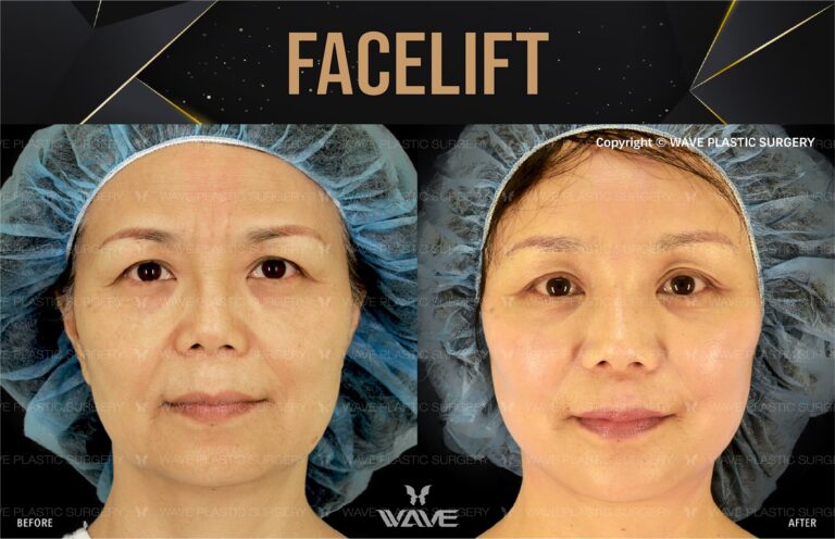 Facelift Transformation