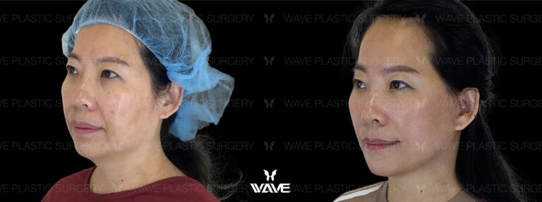 Facelift transformation